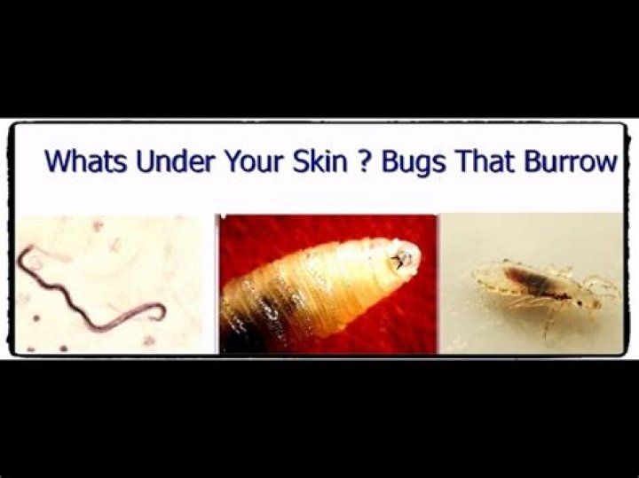 What bugs burrow in your skin?