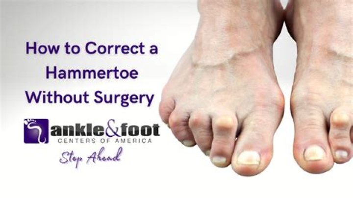 What can you do about hammer toes?