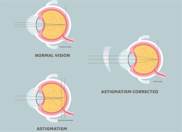 What causes astigmatism?