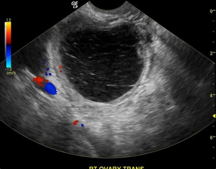 What color is a cyst on an ultrasound?