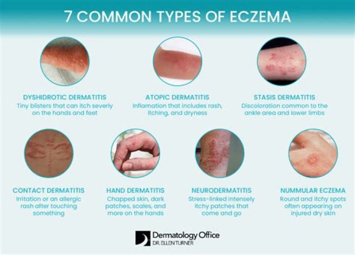 What could trigger eczema?