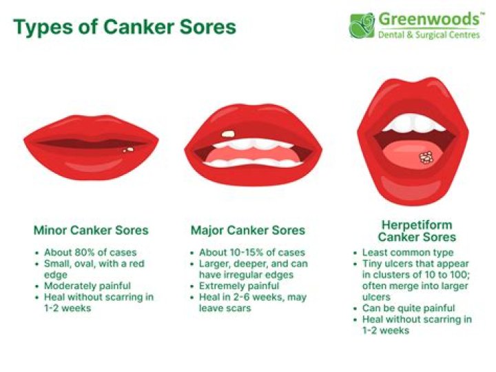 What do canker sores look like?