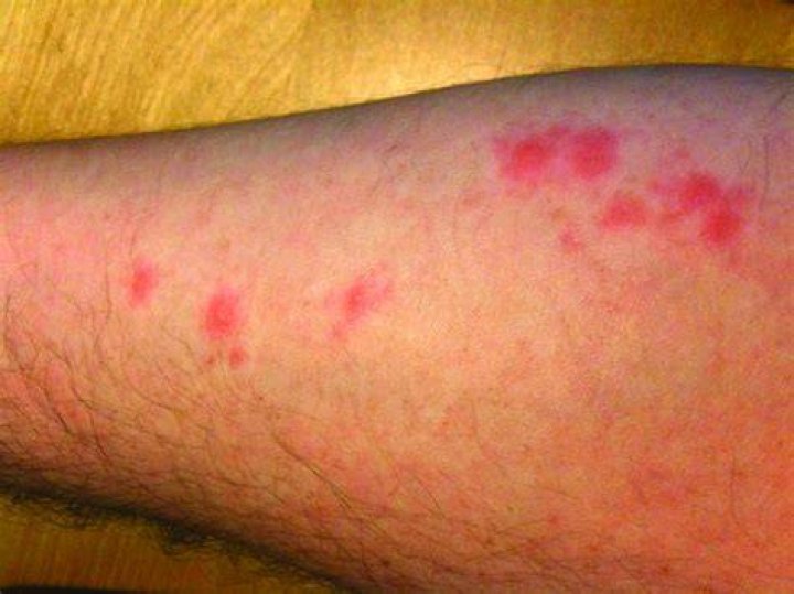 What does a bed bug bite look like on a human?