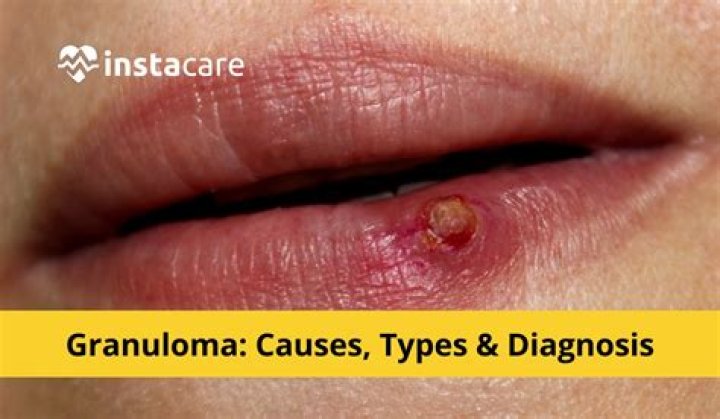 What does a granuloma look like?