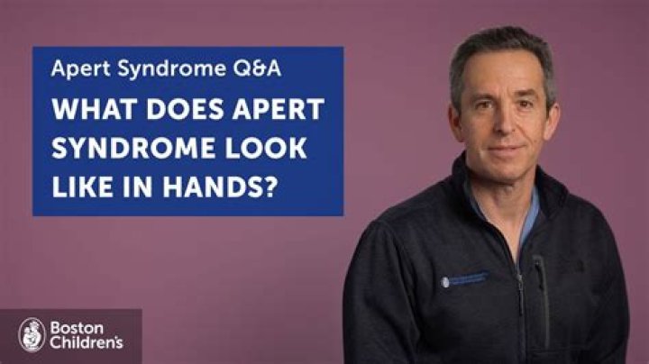 What does Apert syndrome look like?