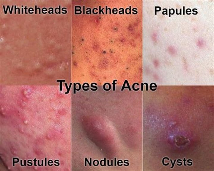 What does cystic acne look like?