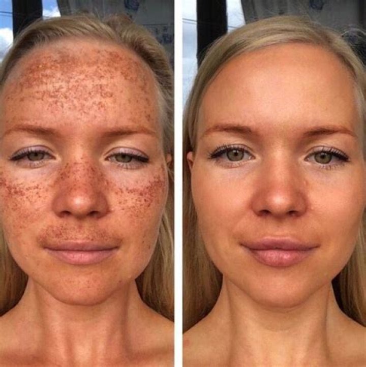 What does your face look like after microdermabrasion?
