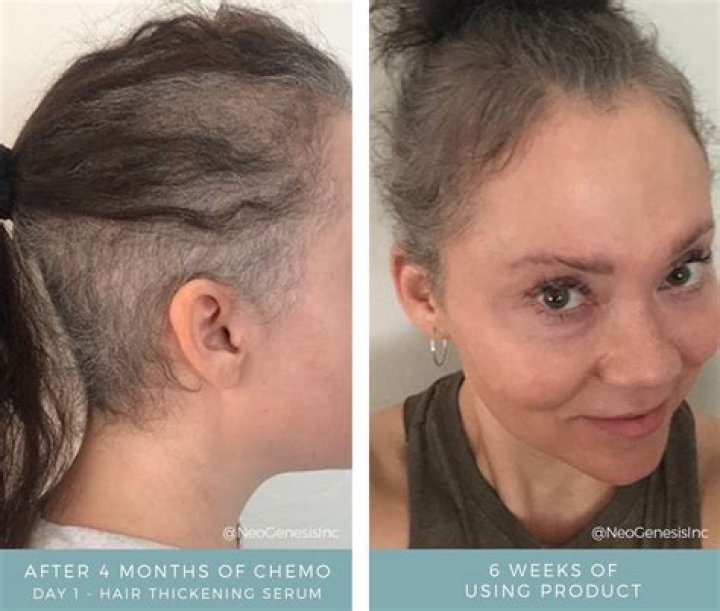What happens if hair doesn't grow back after chemo?