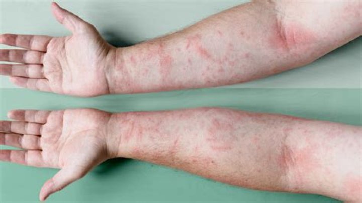 What happens if you don't scratch eczema?