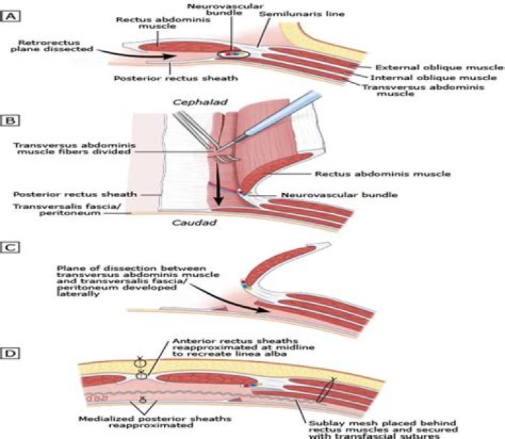 What is a split hernia?