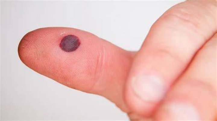 What is the liquid in a burn blister?