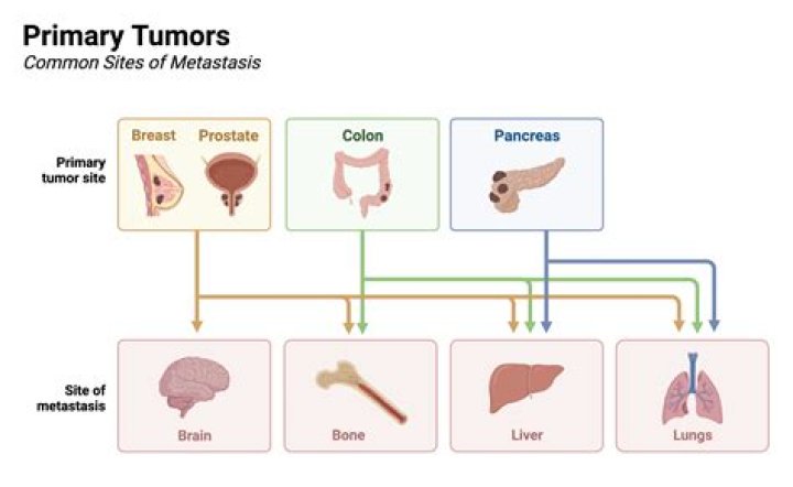 What is the most common site of metastasis?