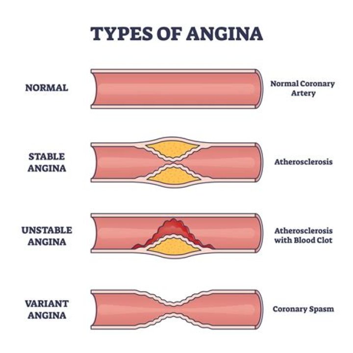 What is throat angina?