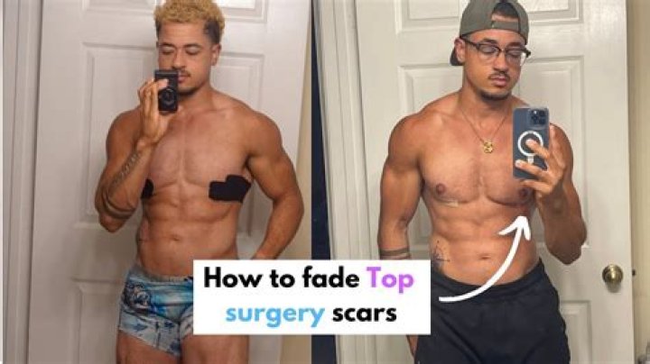 What is top surgery for a woman?