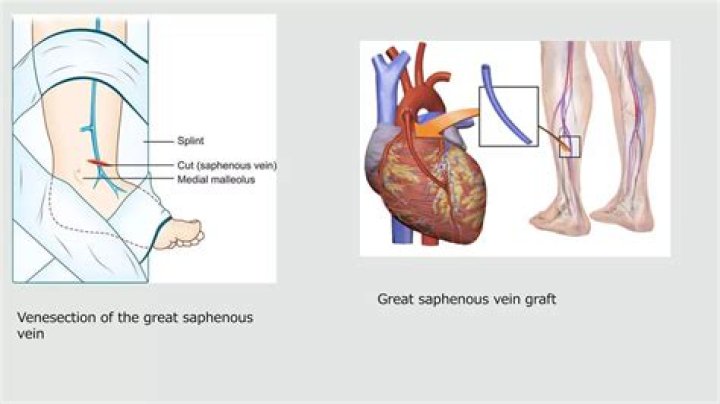 What level of ferritin requires venesection?