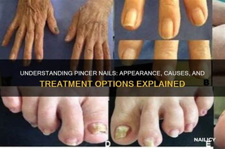 What medications cause pincer nails?