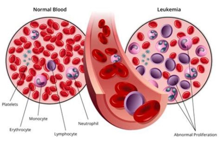 What organs are affected by leukemia?