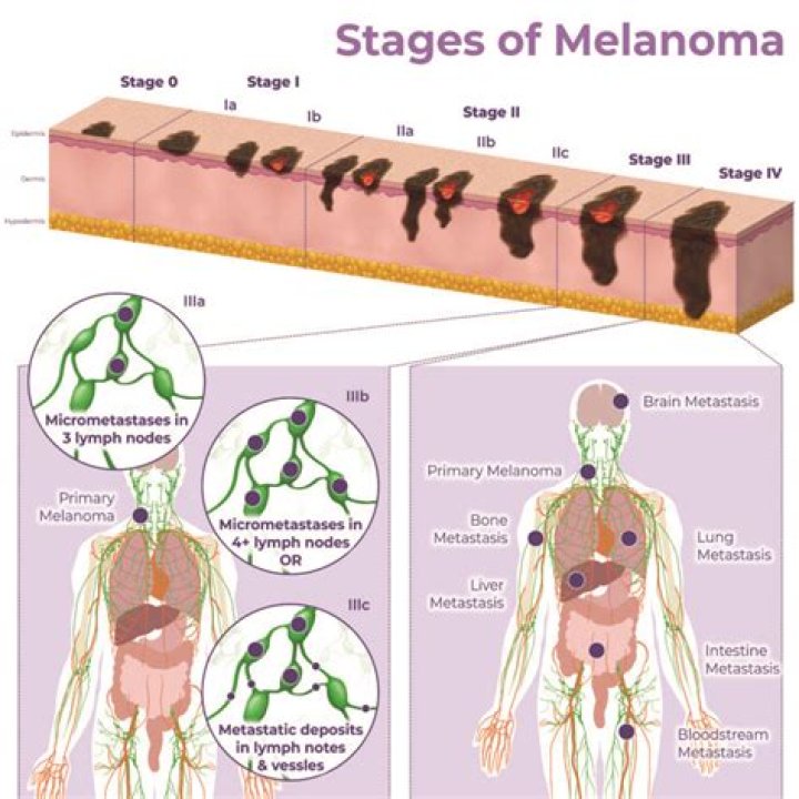 What percent of melanoma is fatal?