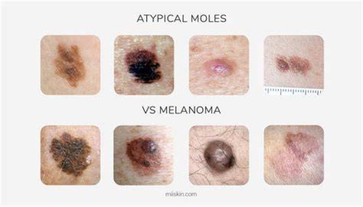 What type of moles are cancerous?