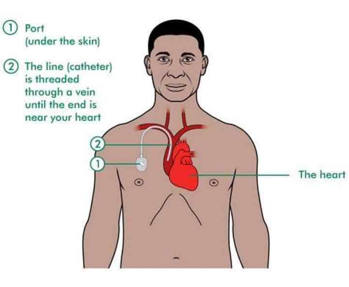 What vein does a chemo port go into?