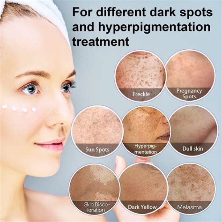Which is the best cream for pigmentation and dark spots?