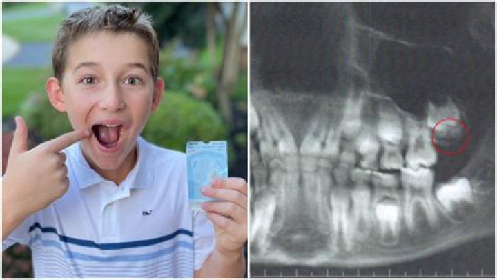 Who was the youngest person to get their wisdom teeth out?
