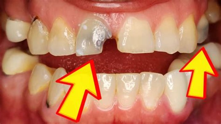 Why are kids teeth grey?