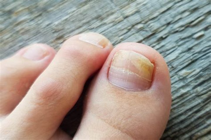 Why are my toenails yellowish brown?