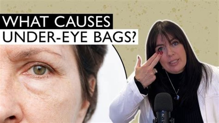 Why do I have bags under my eyes at 13?