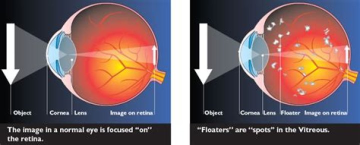 Why do I see dots in my vision?