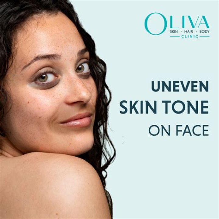 Why do Indians have uneven skin?