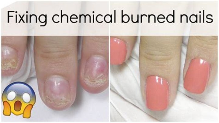 Why do my nails burn when I get acrylics?