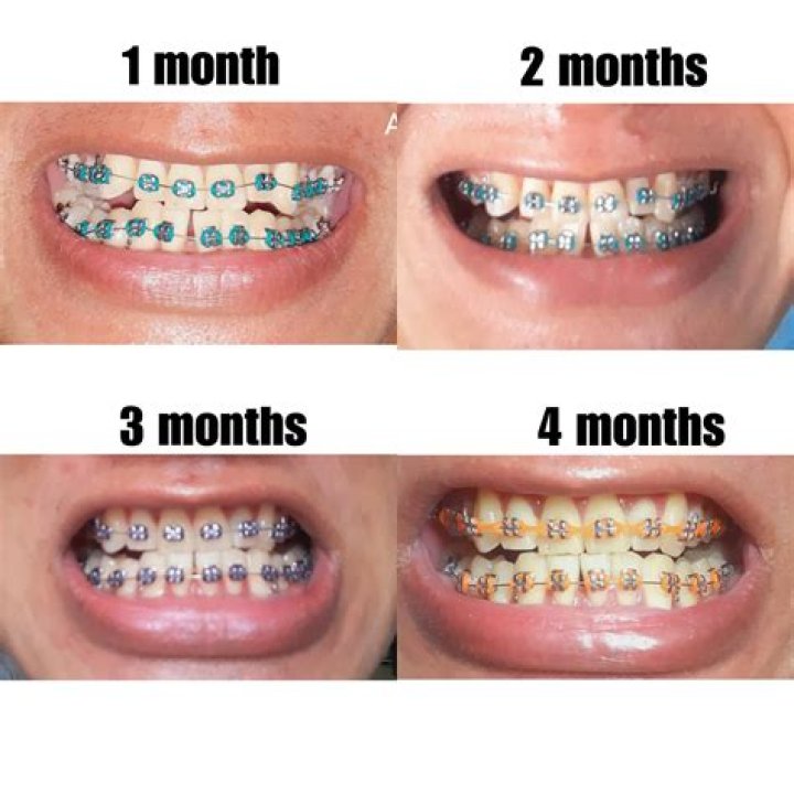 Why do my teeth look yellow with braces?