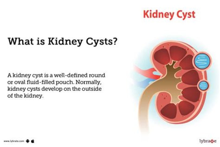 Why do you get cysts?