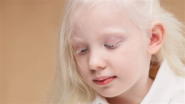 Why is being albino a disability?