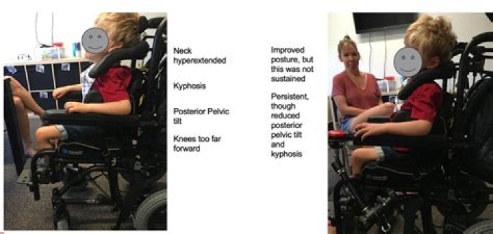 Why would a child need leg braces?
