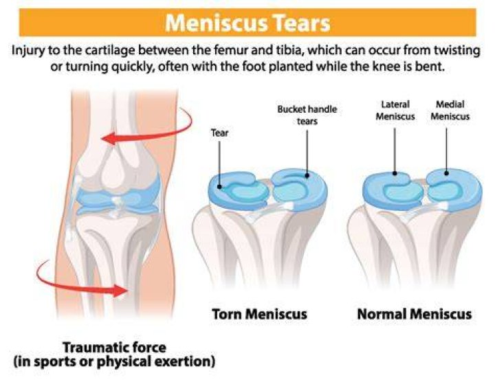 Will an xray show a torn meniscus?
