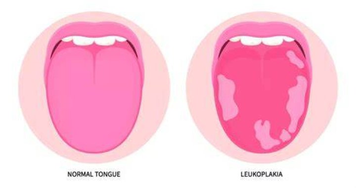 Will leukoplakia go away?